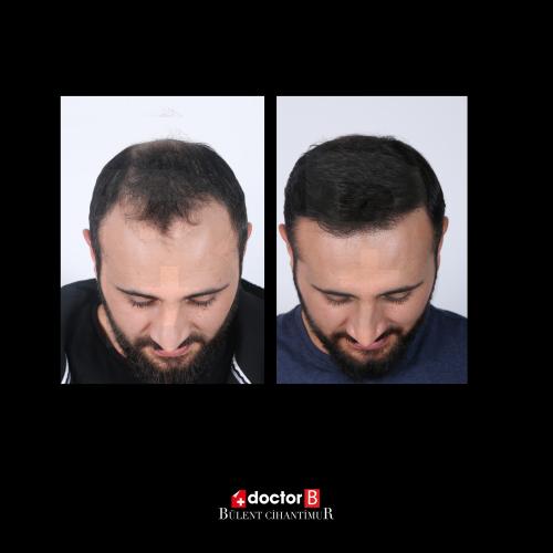 Organic hair transplantation Before / After photo